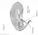 Fig. 06 - Method for shunting toxic substances from a brain ventricle to the sinus system