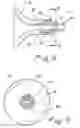 Fig. 06 - Ureteral access sheath