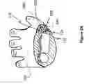 Fig. 03 - Apparatus and method for releasing tendon sheath