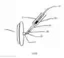Fig. 12 - Occlusion device and surgical instrument and method for its implantation/explantation