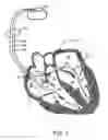 Fig. 02 - Method and system for detecting capture using a coronary vein electrode