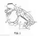 Fig. 02 - Delivery catheter