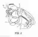 Fig. 03 - Delivery catheter