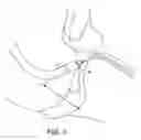Fig. 04 - Delivery catheter