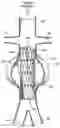 Fig. 01 - ENDOLUMINAL VASCULAR PROSTHESIS