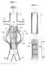Fig. 02 - ENDOLUMINAL VASCULAR PROSTHESIS