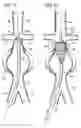 Fig. 10 - ENDOLUMINAL VASCULAR PROSTHESIS