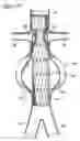 Fig. 13 - ENDOLUMINAL VASCULAR PROSTHESIS