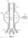 Fig. 02 - Endoluminal device and system and method for detecting a change in pressure differential across an endoluminal device