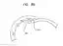 Fig. 10 - Stent with spiral side-branch