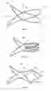 Fig. 05 - Devices and methods for treatment of venous valve insufficiency