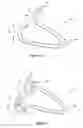 Fig. 06 - Devices and methods for treatment of venous valve insufficiency