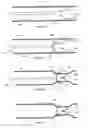 Fig. 10 - Devices and methods for treatment of venous valve insufficiency