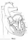Fig. 02 - CATHETER BASED TISSUE FASTENING SYSTEMS AND METHODS