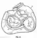 Fig. 06 - CATHETER BASED TISSUE FASTENING SYSTEMS AND METHODS