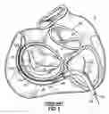 Fig. 07 - CATHETER BASED TISSUE FASTENING SYSTEMS AND METHODS