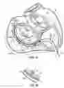 Fig. 08 - CATHETER BASED TISSUE FASTENING SYSTEMS AND METHODS