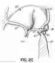 Fig. 10 - CATHETER BASED TISSUE FASTENING SYSTEMS AND METHODS