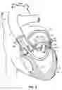Fig. 11 - CATHETER BASED TISSUE FASTENING SYSTEMS AND METHODS