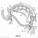 Fig. 14 - CATHETER BASED TISSUE FASTENING SYSTEMS AND METHODS