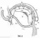 Fig. 15 - CATHETER BASED TISSUE FASTENING SYSTEMS AND METHODS
