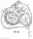 Fig. 16 - CATHETER BASED TISSUE FASTENING SYSTEMS AND METHODS