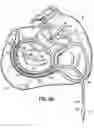 Fig. 17 - CATHETER BASED TISSUE FASTENING SYSTEMS AND METHODS