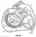 Fig. 18 - CATHETER BASED TISSUE FASTENING SYSTEMS AND METHODS