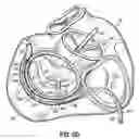 Fig. 19 - CATHETER BASED TISSUE FASTENING SYSTEMS AND METHODS