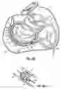 Fig. 20 - CATHETER BASED TISSUE FASTENING SYSTEMS AND METHODS