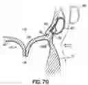 Fig. 24 - CATHETER BASED TISSUE FASTENING SYSTEMS AND METHODS