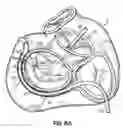 Fig. 25 - CATHETER BASED TISSUE FASTENING SYSTEMS AND METHODS