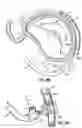Fig. 26 - CATHETER BASED TISSUE FASTENING SYSTEMS AND METHODS