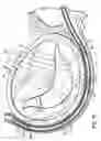 Fig. 28 - CATHETER BASED TISSUE FASTENING SYSTEMS AND METHODS
