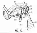 Fig. 31 - CATHETER BASED TISSUE FASTENING SYSTEMS AND METHODS