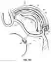 Fig. 33 - CATHETER BASED TISSUE FASTENING SYSTEMS AND METHODS