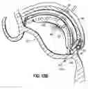 Fig. 34 - CATHETER BASED TISSUE FASTENING SYSTEMS AND METHODS