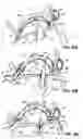 Fig. 41 - CATHETER BASED TISSUE FASTENING SYSTEMS AND METHODS