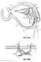 Fig. 44 - CATHETER BASED TISSUE FASTENING SYSTEMS AND METHODS