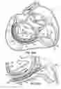 Fig. 48 - CATHETER BASED TISSUE FASTENING SYSTEMS AND METHODS