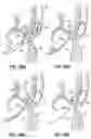 Fig. 69 - CATHETER BASED TISSUE FASTENING SYSTEMS AND METHODS