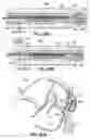 Fig. 72 - CATHETER BASED TISSUE FASTENING SYSTEMS AND METHODS