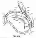 Fig. 74 - CATHETER BASED TISSUE FASTENING SYSTEMS AND METHODS