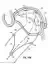 Fig. 76 - CATHETER BASED TISSUE FASTENING SYSTEMS AND METHODS