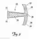 Fig. 04 - Facet repair and stabilization