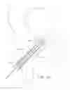 Fig. 10 - BALL AND SHAFT OF JOINT PROTHESIS