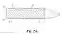 Fig. 03 - Anti-reflux stent
