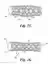 Fig. 13 - Anti-reflux stent