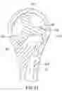 Fig. 12 - FLUID DRIVEN TOOTHBRUSH