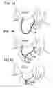 Fig. 02 - Clasp and method for assembling the same